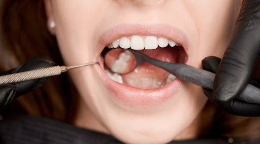 Understanding the Benefits of Teeth Filling Composite in Charlotte, NC for Modern Dental Restoration